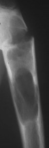 tumor-humerus